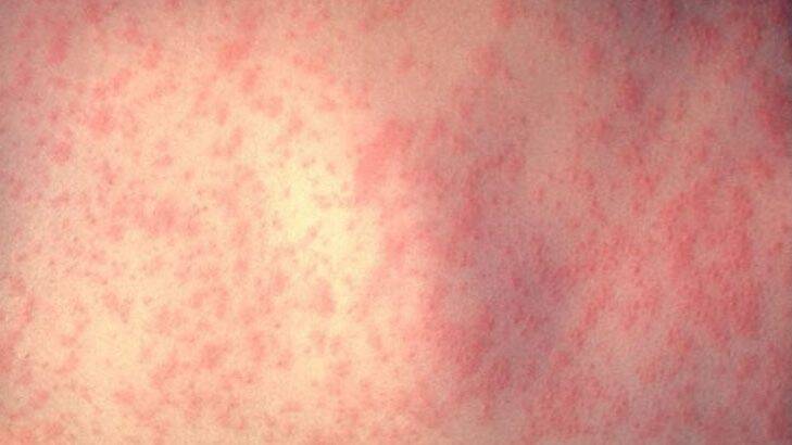 BEWARE: A non-itchy rash is one of the symptoms of measles. Others include a fever and sore eyes.