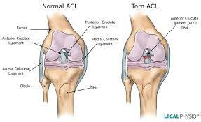 ACL injuries are on the rise. 