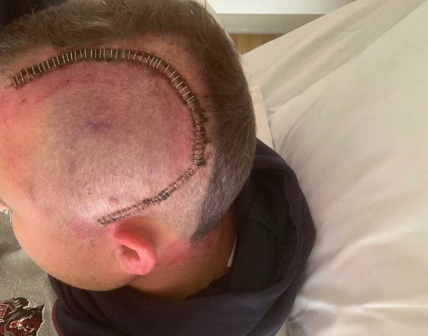 SURGERY: Marcus Whelan's scar following surgery for a brain tumour. Picture: supplied